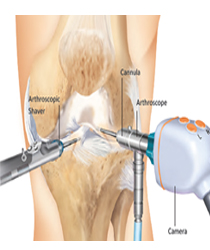 treatments for sports injuries in andhra pradesh, ligament injury treatments in andhra pradesh, ligament surgery treatments in andhra pradesh, torn ligament treatments in andhra pradesh, torn ligament Surgery in andhra pradesh, torn ligament Treatment & Recovery Time in andhra pradesh, meniscal tear treatments in andhra pradesh in andhra pradesh, Torn Meniscus Symptoms  in andhra pradesh, Surgery treatments in andhra pradesh, Treatment & Recovery Time in andhra pradesh